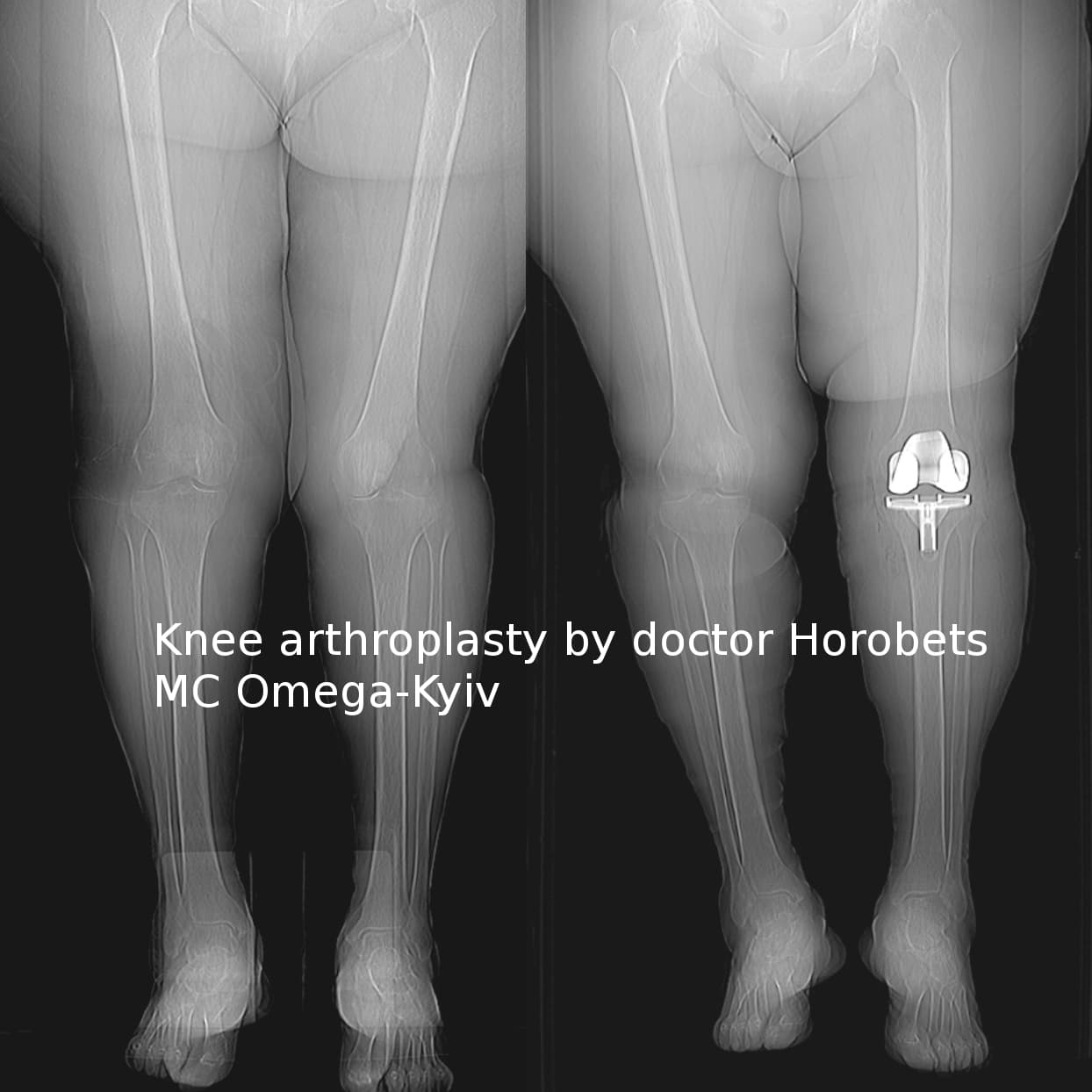Total Knee Replacement