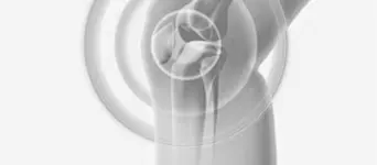 Revision Knee Replacement Revision Knee Replacement